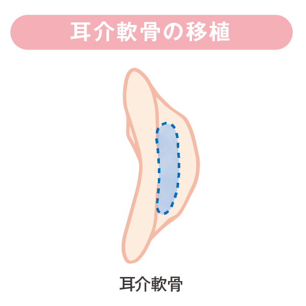 耳介軟骨の移植
