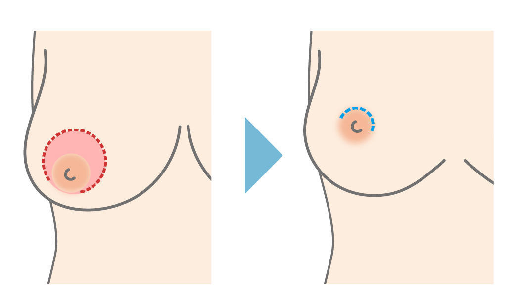 クレッセント型（ミニリフト）