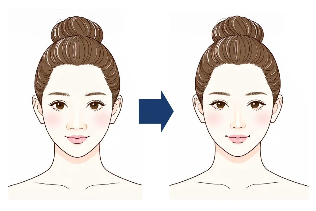 鼻尖形成（だんご鼻縮小）