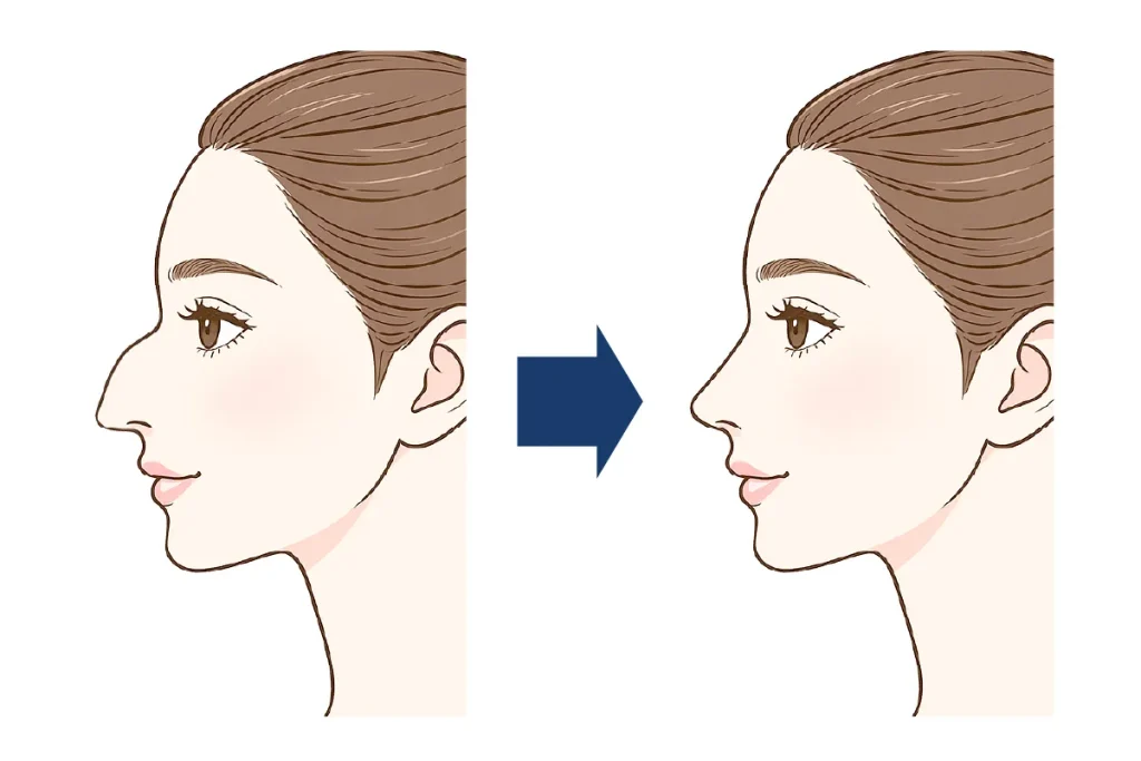 低鼻術（わし鼻修正）