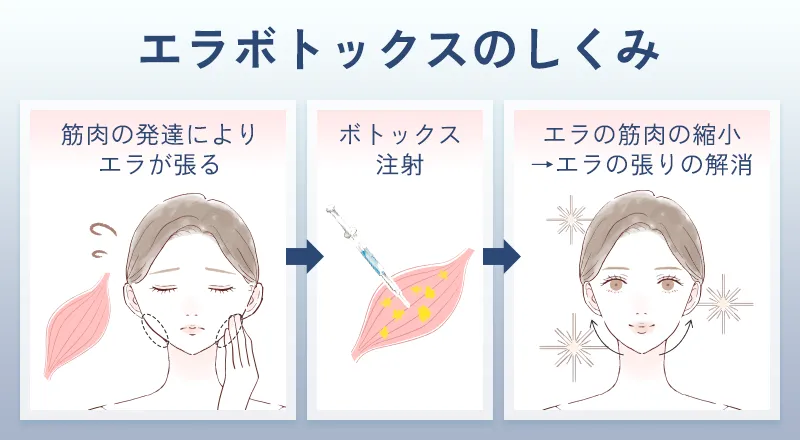 エラボトックスの仕組み