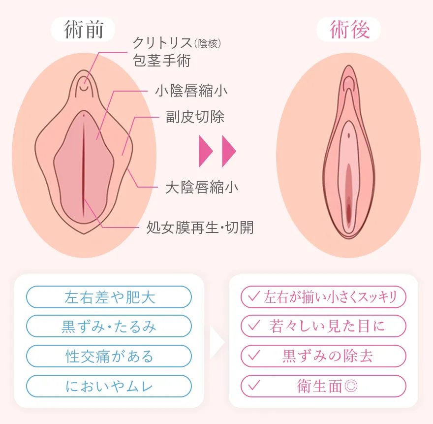 外陰部の婦人科形成