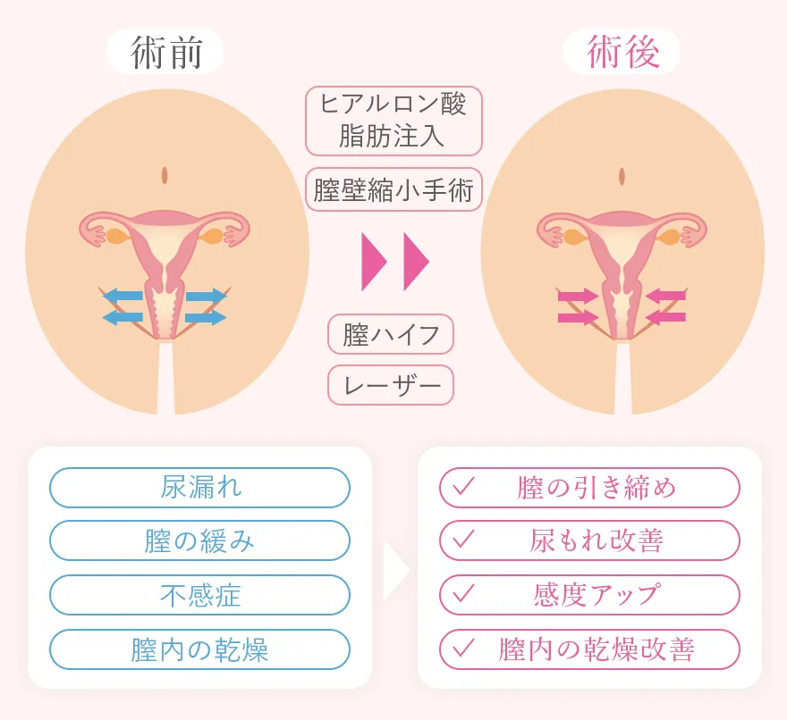 膣引き締めの婦人科形成