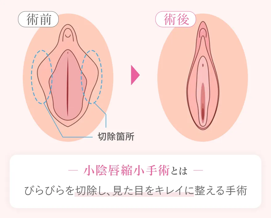 小陰唇の縮小手術