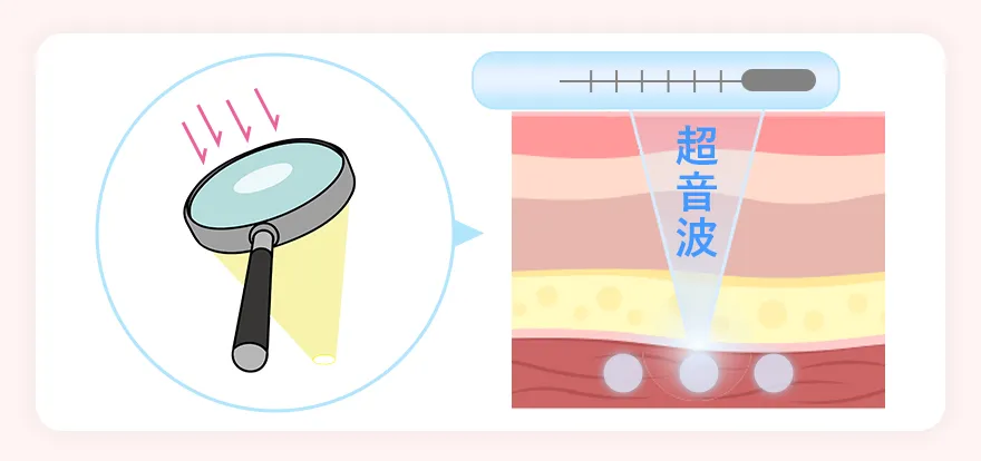 膣ハイフの仕組み