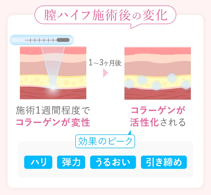 膣ハイフ後の変化