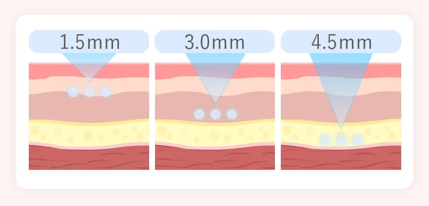 膣ハイフの照射の深さ