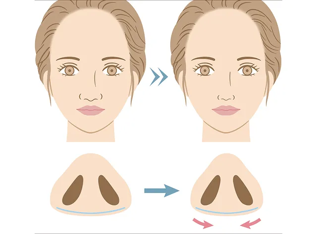 鼻整形メニュー