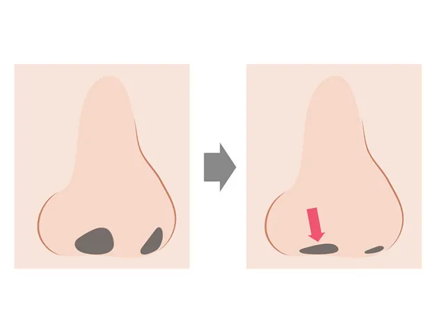 鼻整形メニュー