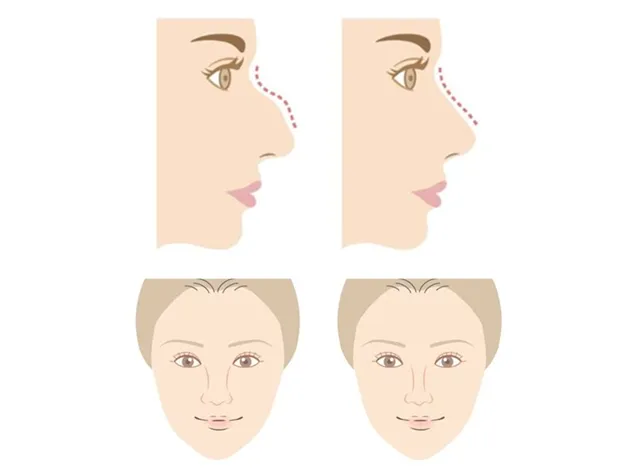 鼻整形メニュー