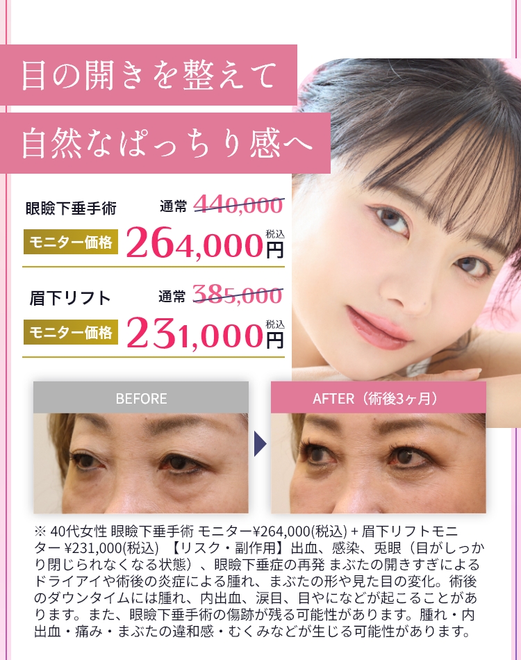 目の開きを整えて自然なぱっちり感へ