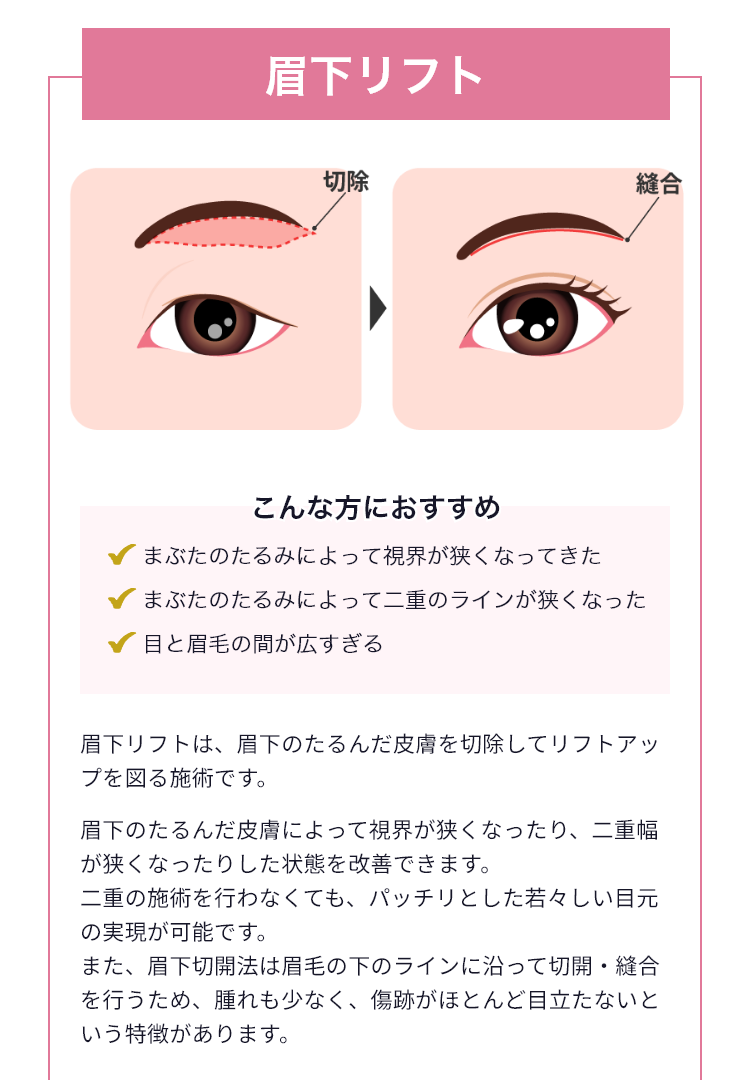 眉下リフト