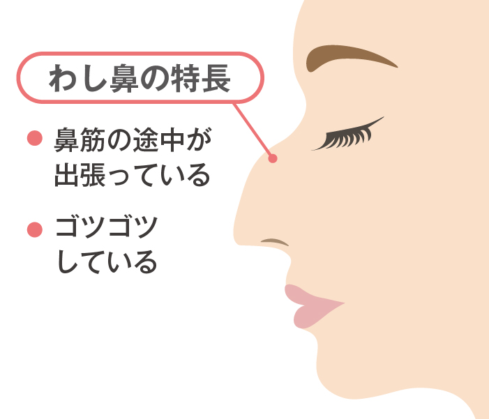 わし鼻とは