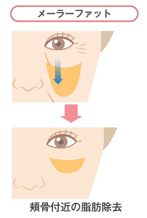 メーラーファット除去について