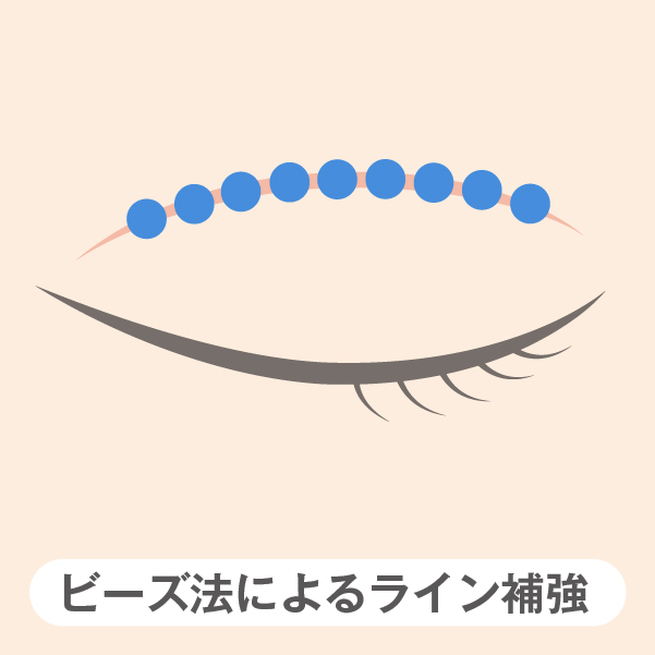 切除法やビーズ法や埋没法の再手術 「ビーズ法によるラインの補強」