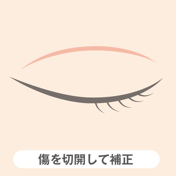 切開による再手術 「キズを切除して修正」