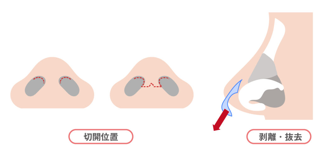 異物・挿入物の抜去