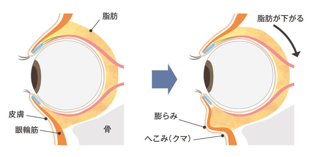 遺伝や加齢により目の周りを覆っている脂肪が突出する