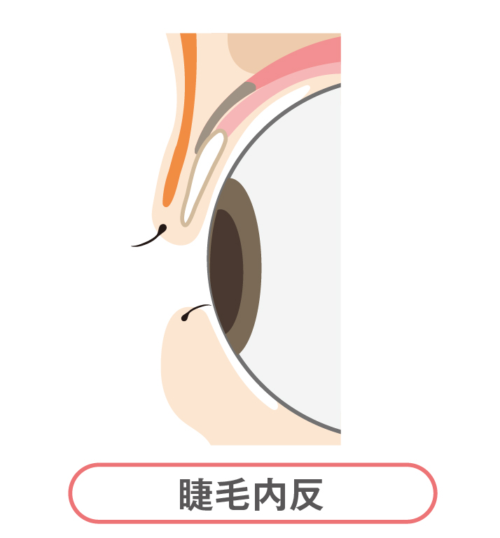 睫毛内反（しょうもうないはん）