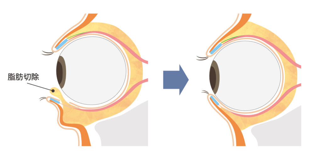 脱脂による目の下の膨らみを解消