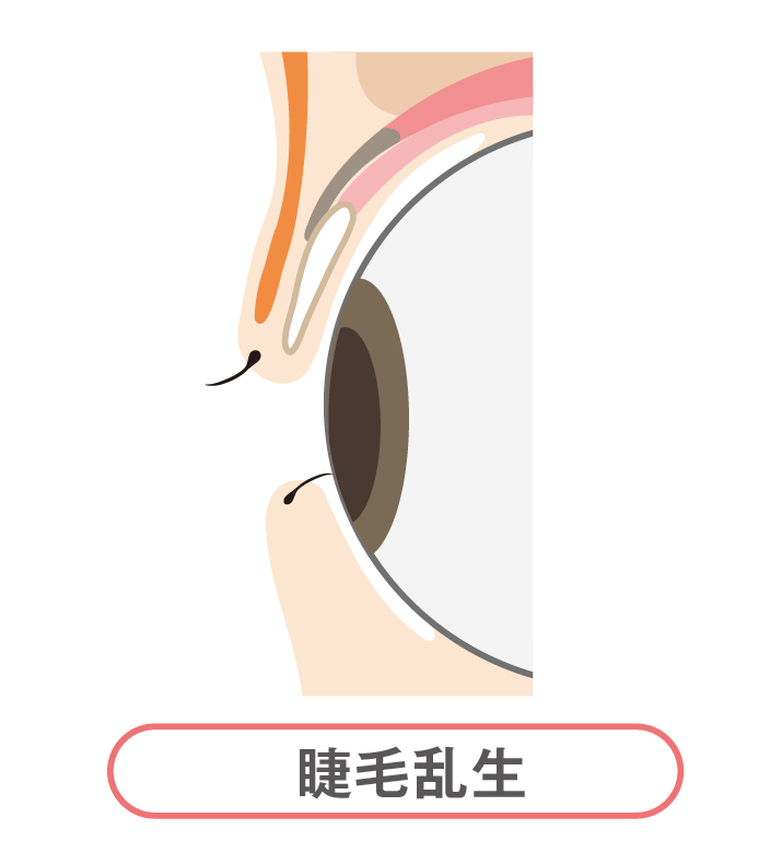 睫毛乱生(しょうもうらんせい)