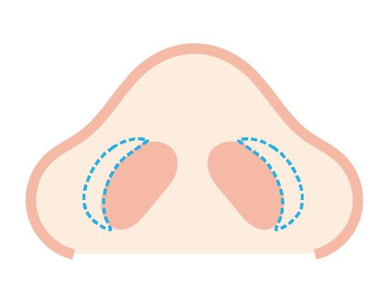 切開のデザインを決定