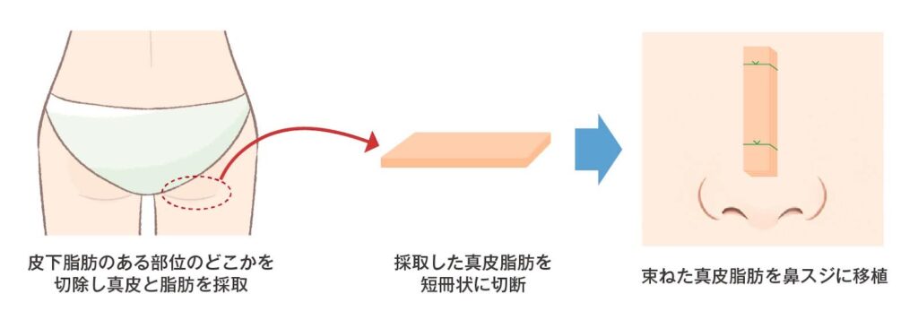 真皮脂肪移植を使用する方法
