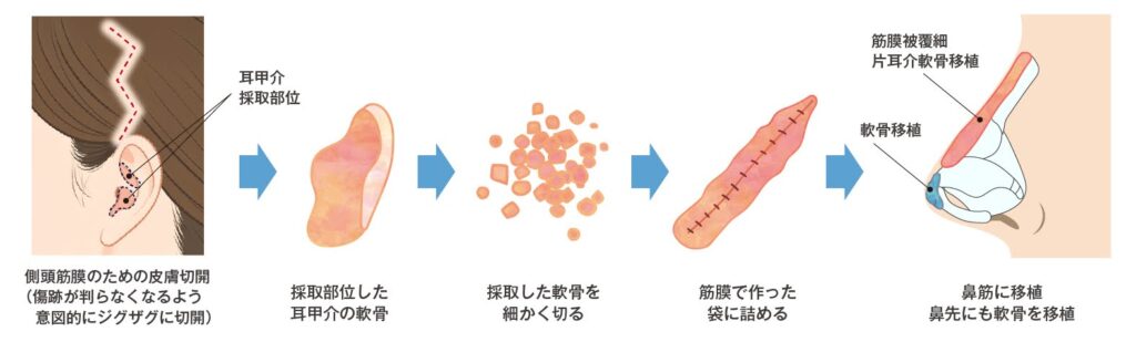 耳介軟骨＋筋膜を使用する方法