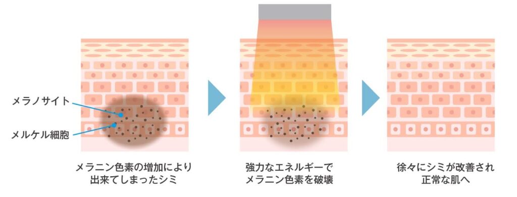 Qスイッチルビーレーザーとは