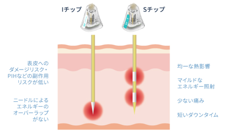 少ない痛みと短いダウンタイム