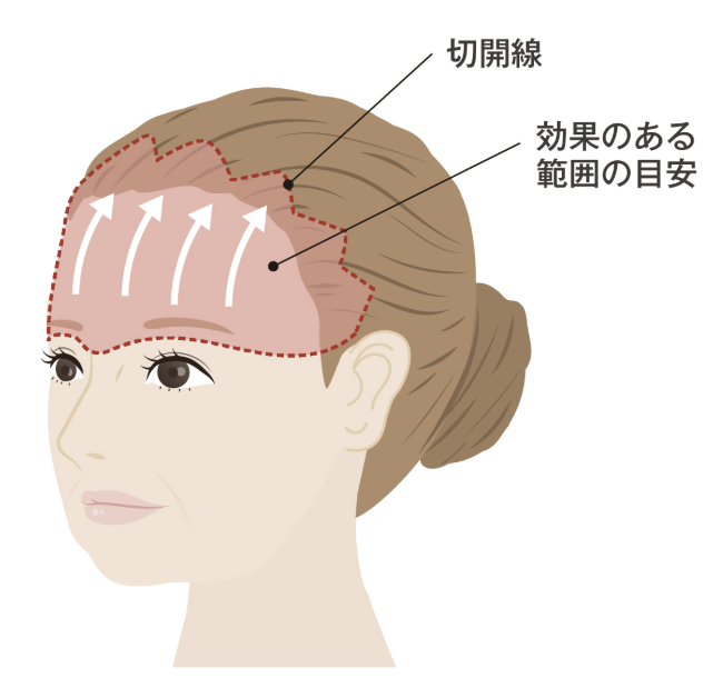 前額リフト