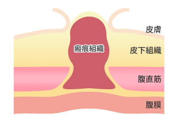 臍突出症