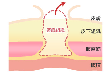 臍突出症