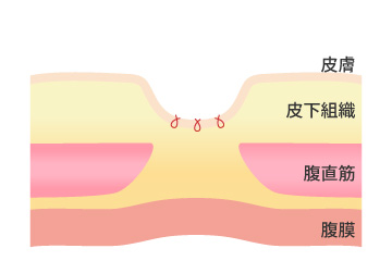 臍突出症
